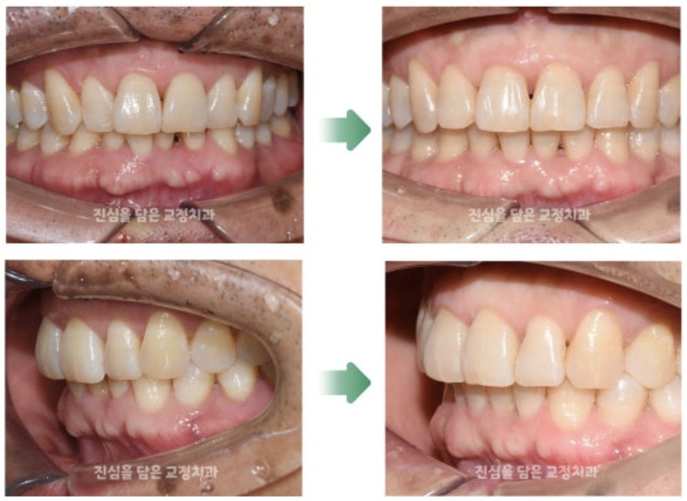 삐뚤어진 앞니를 가진 50대 환자분의 부분교정 사례